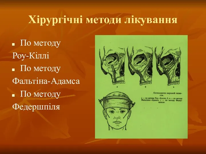 Хірургічні методи лікування По методу Роу-Кіллі По методу Фальтіна-Адамса По методу Федершпіля