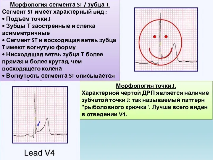 Морфология сегмента ST / зубца T. Сегмент ST имеет характерный