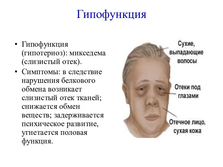 Гипофункция Гипофункция (гипотериоз): микседема (слизистый отек). Симптомы: в следствие нарушения