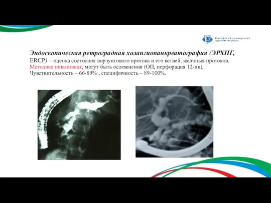 Эндоскопическая ретроградная холангиопанкреатография (ЭРХПГ, ERCP) – оценка состояния вирзунгового протока