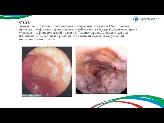 ФГДС вдавление по задней стенке желудка, деформация желудка и 12п.к.,