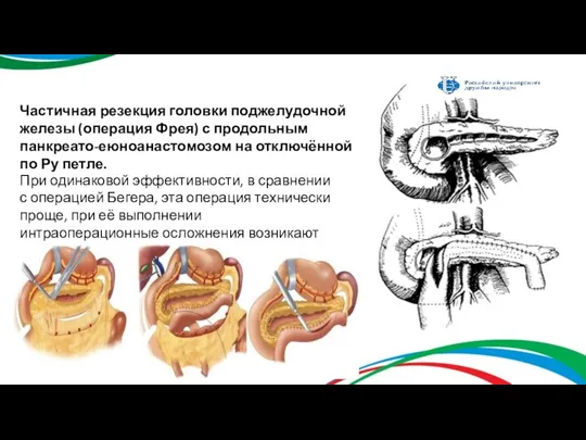 Частичная резекция головки поджелудочной железы (операция Фрея) с продольным панкреато-еюноанастомозом