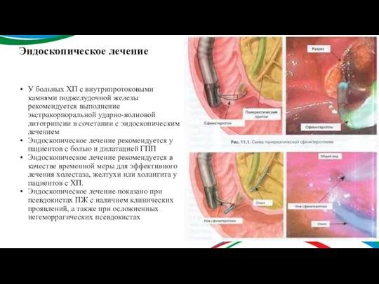 Эндоскопическое лечение У больных ХП с внутрипротоковыми камнями поджелудочной железы