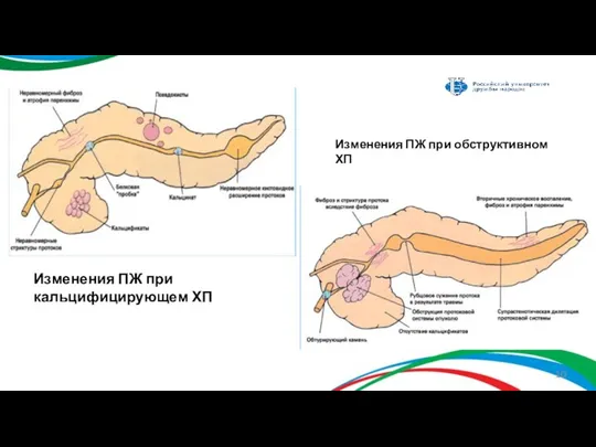 Изменения ПЖ при кальцифицирующем ХП Изменения ПЖ при обструктивном ХП