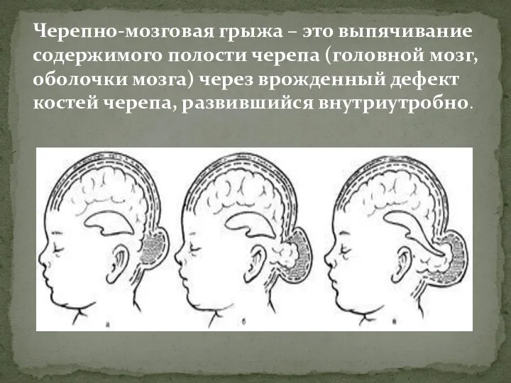 Черепно-мозговая грыжа – это выпячивание содержимого полости черепа (головной мозг,