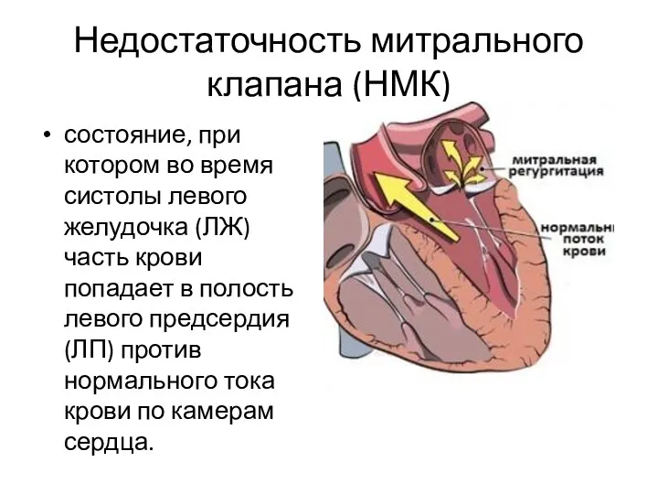 Недостаточность митрального клапана (НМК) состояние, при котором во время систолы левого желудочка (ЛЖ)