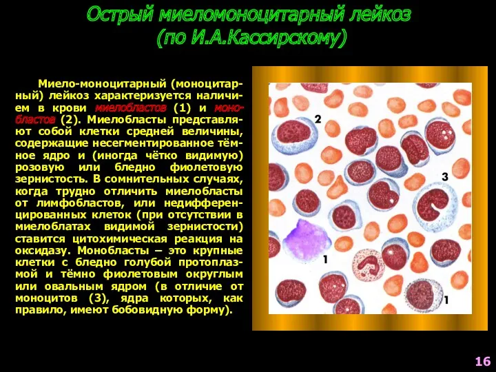 Острый миеломоноцитарный лейкоз (по И.А.Кассирскому) Миело-моноцитарный (моноцитар-ный) лейкоз характеризуется наличи-ем