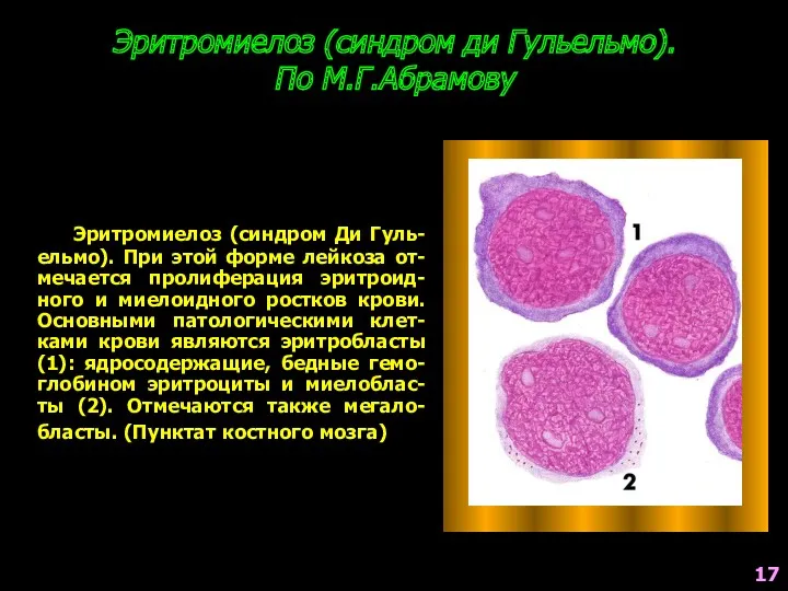 Эритромиелоз (синдром ди Гульельмо). По М.Г.Абрамову Эритромиелоз (синдром Ди Гуль-ельмо).