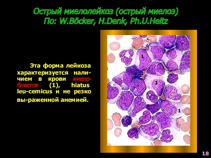 Острый миелолейкоз (острый миелоз) По: W.Böcker, H.Denk, Ph.U.Heitz Эта форма