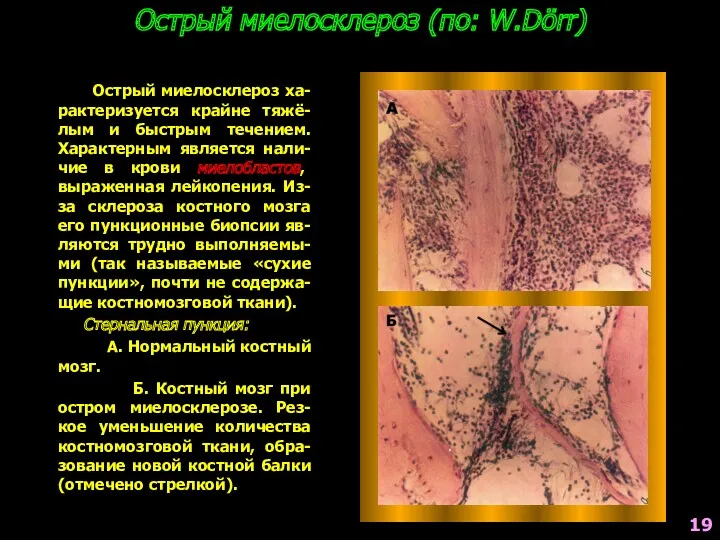 Острый миелосклероз (по: W.Dörr) Острый миелосклероз ха-рактеризуется крайне тяжё-лым и