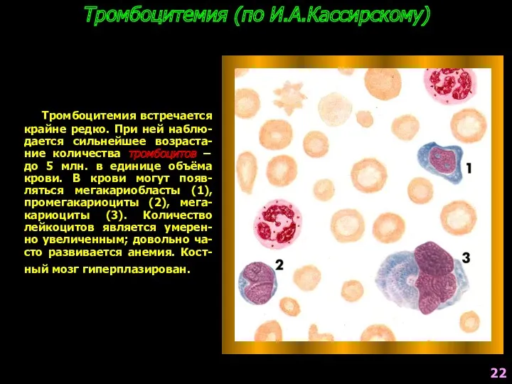 Тромбоцитемия (по И.А.Кассирскому) Тромбоцитемия встречается крайне редко. При ней наблю-дается