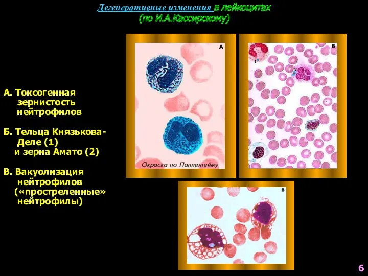 Дегенеративные изменения в лейкоцитах (по И.А.Кассирскому) А. Токсогенная зернистость нейтрофилов