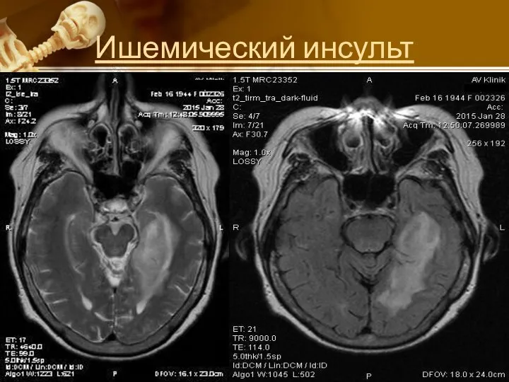 Ишемический инсульт