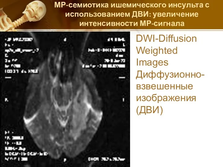 МР-семиотика ишемического инсульта с использованием ДВИ: увеличение интенсивности МР-сигнала DWI-Diffusion Weighted Images Диффузионно-взвешенные изображения(ДВИ)