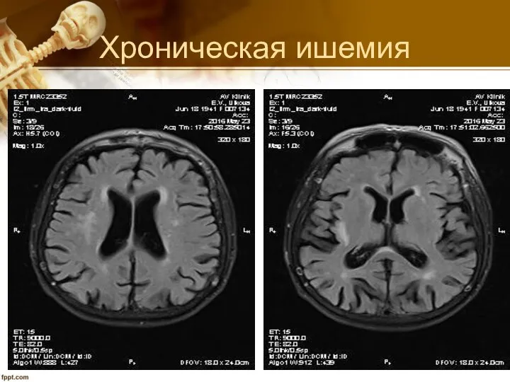 Хроническая ишемия