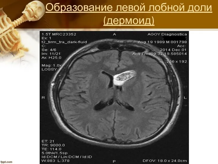 Образование левой лобной доли (дермоид)