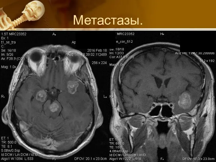 Метастазы.