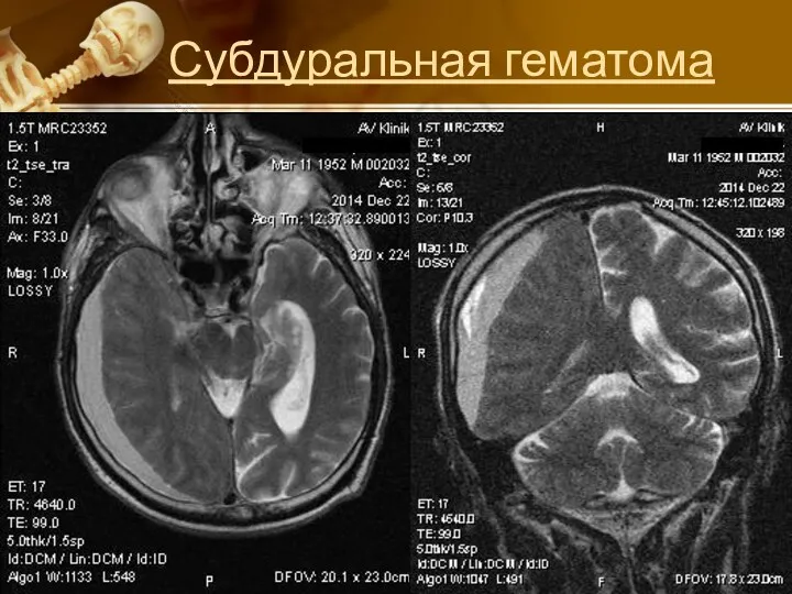 Субдуральная гематома