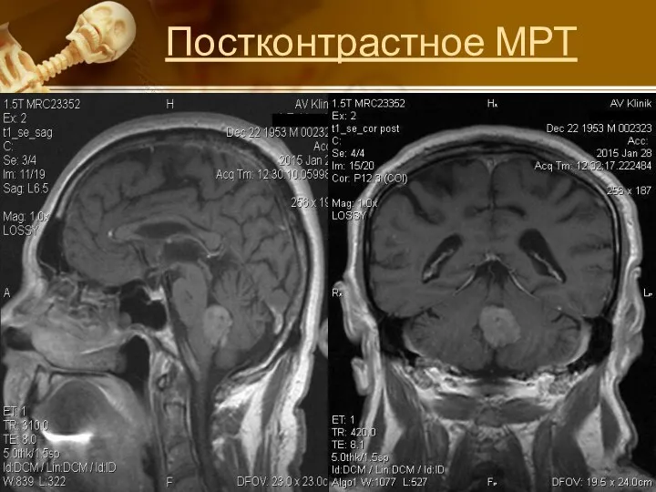 Постконтрастное МРТ