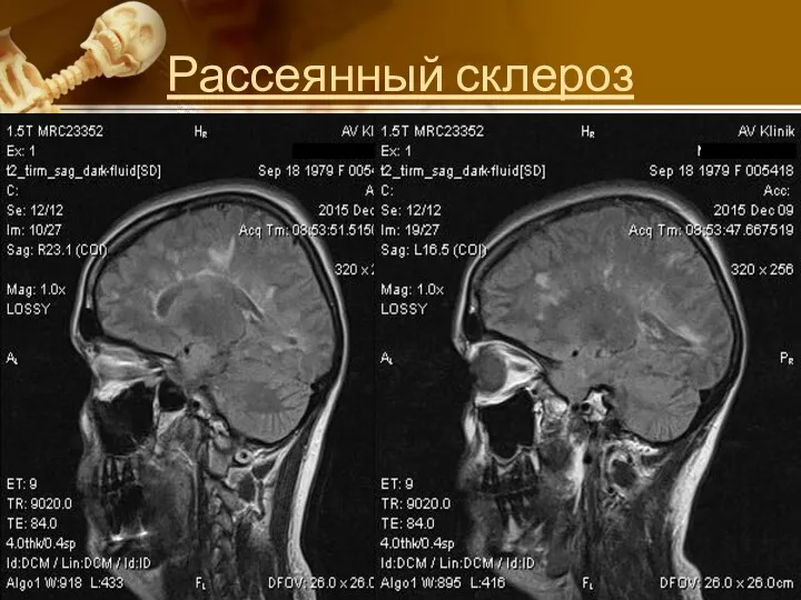 Рассеянный склероз