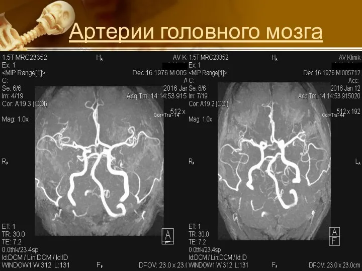 Артерии головного мозга