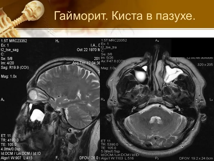 Гайморит. Киста в пазухе.