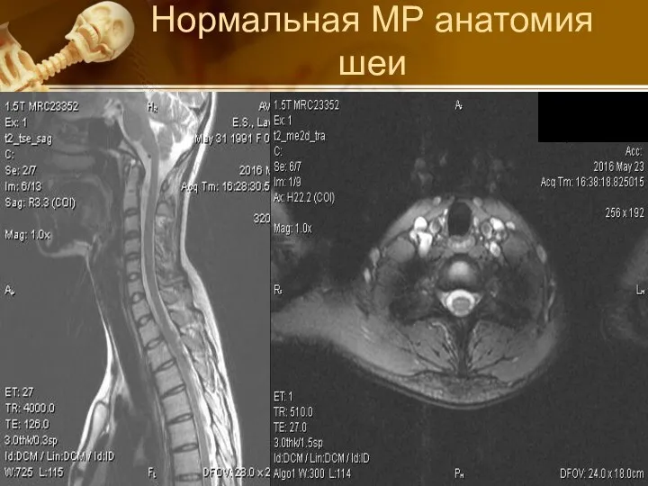 Нормальная МР анатомия шеи