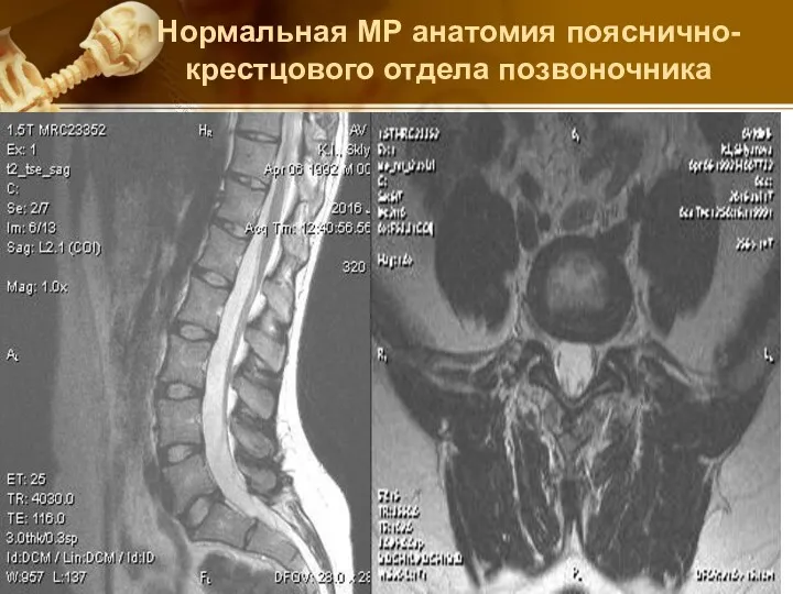 Нормальная МР анатомия пояснично-крестцового отдела позвоночника