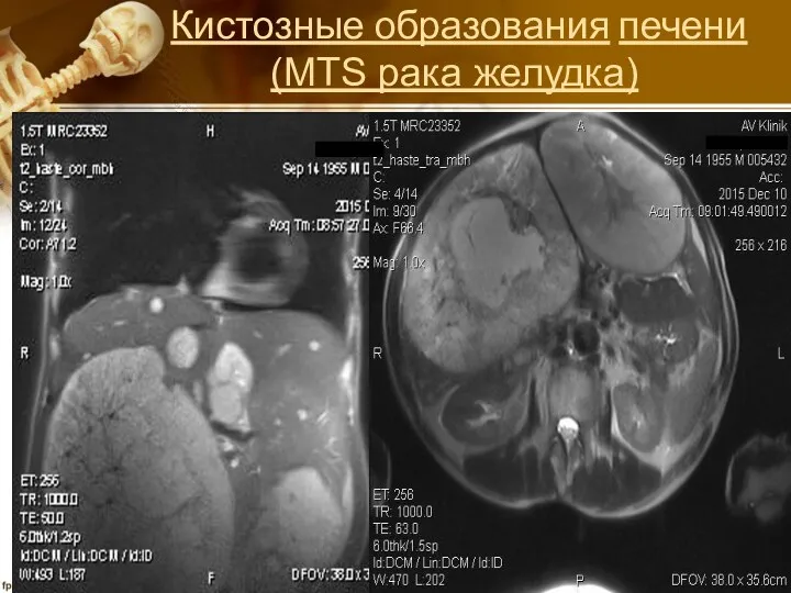 Кистозные образования печени (MTS рака желудка)