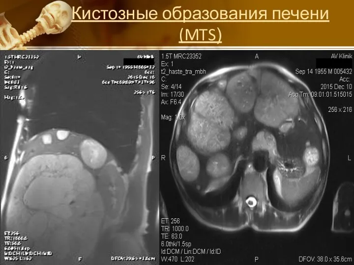 Кистозные образования печени (MTS)