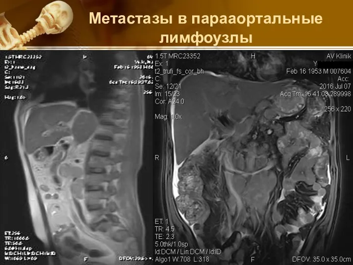 Метастазы в парааортальные лимфоузлы