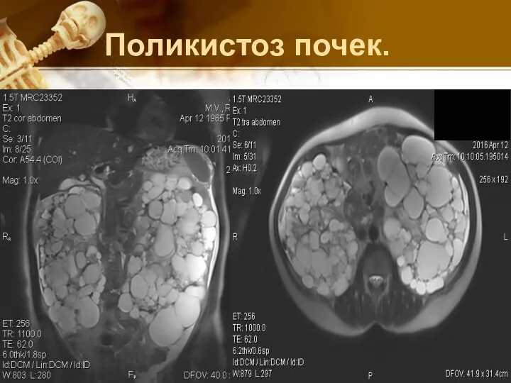 Поликистоз почек.