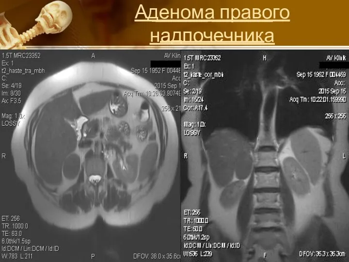 ______ _______ ____________ Аденома правого надпочечника