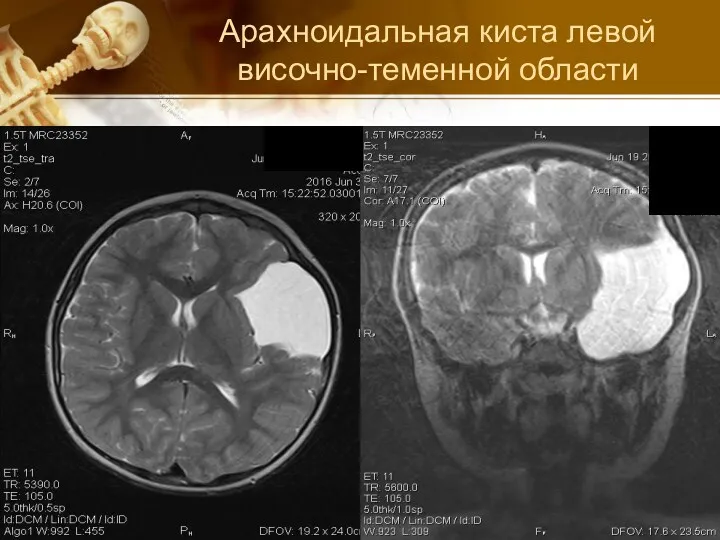 Арахноидальная киста левой височно-теменной области