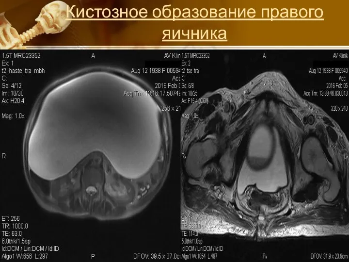 Кистозное образование правого яичника