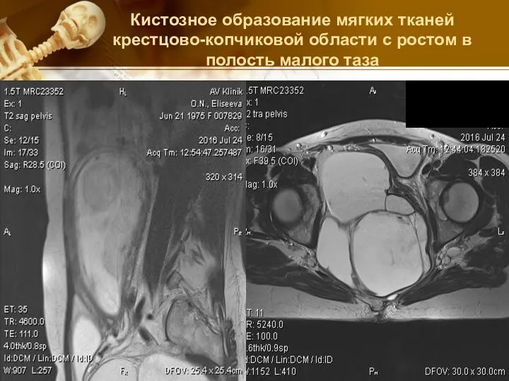 Кистозное образование мягких тканей крестцово-копчиковой области с ростом в полость малого таза