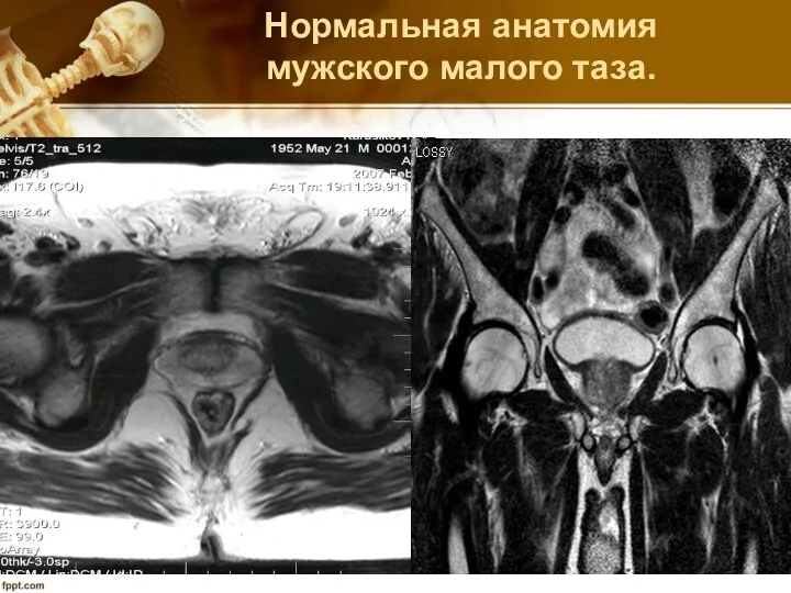 Нормальная анатомия мужского малого таза.