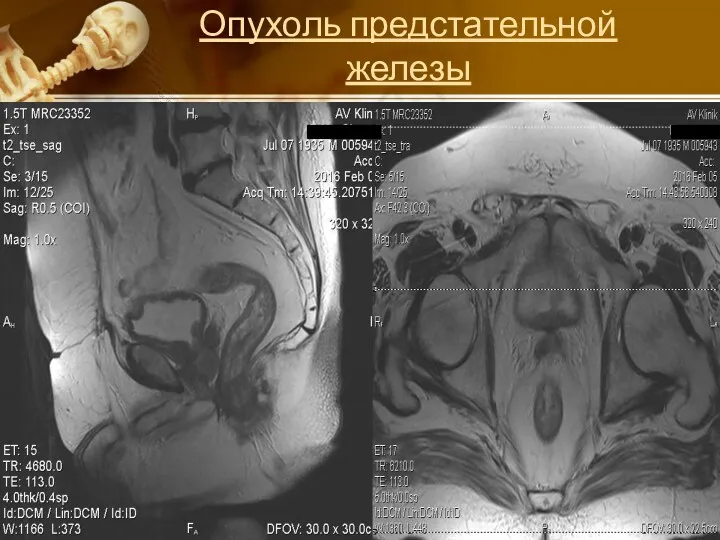 Опухоль предстательной железы