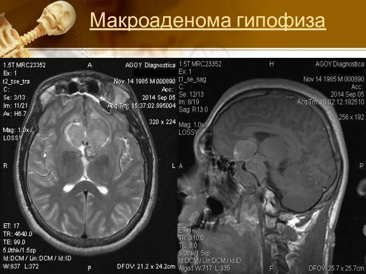 Макроаденома гипофиза