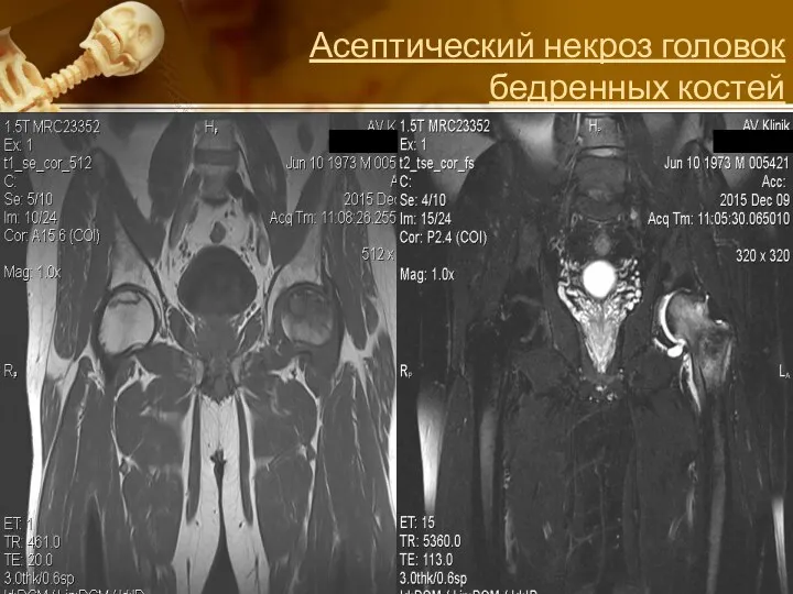 Асептический некроз головок бедренных костей