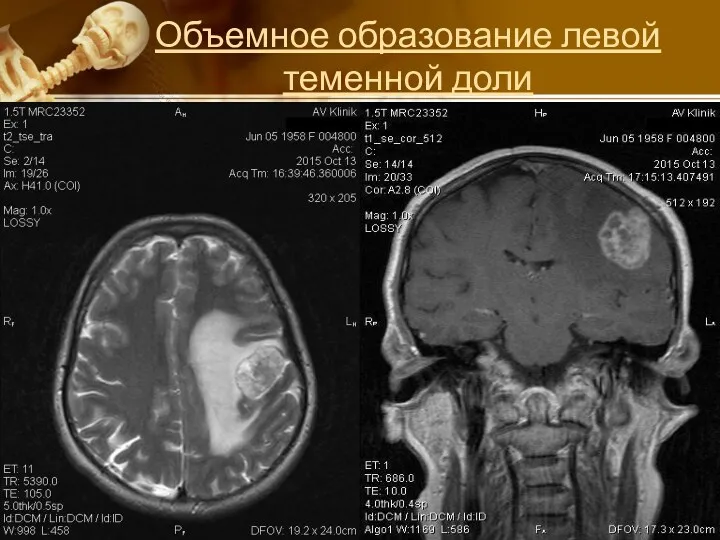 Объемное образование левой теменной доли