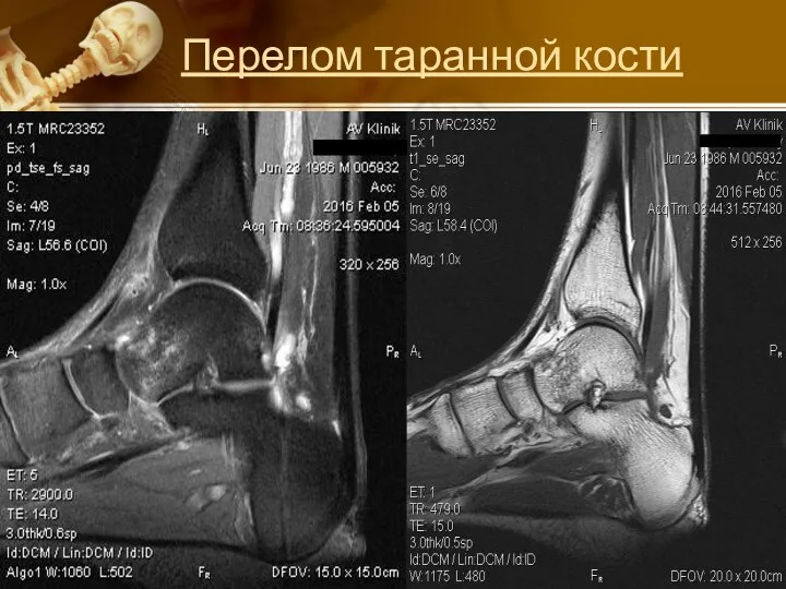 Перелом таранной кости