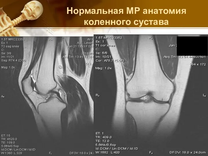 Нормальная МР анатомия коленного сустава