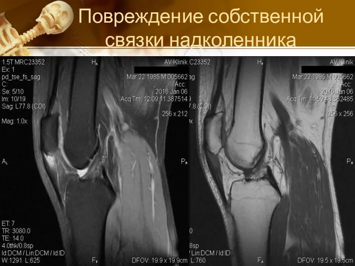 Повреждение собственной связки надколенника