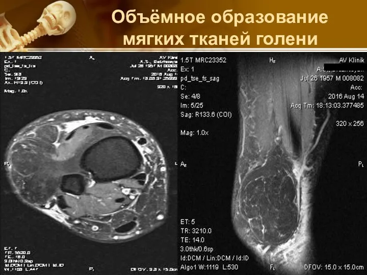 Объёмное образование мягких тканей голени