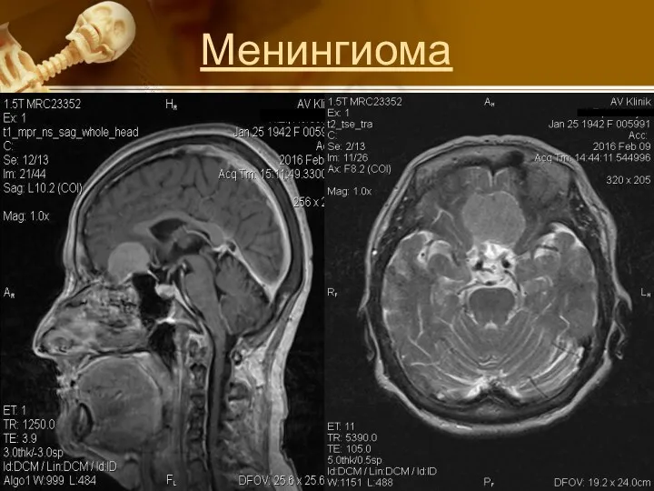 Менингиома