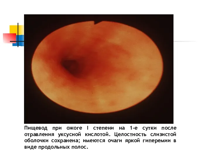 Пищевод при ожоге I степени на 1-е сутки после отравления