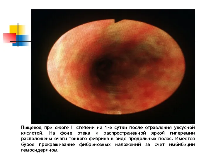 Пищевод при ожоге II степени на 1-е сутки после отравления