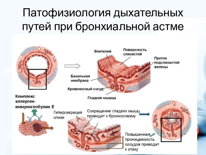 Патофизиология дыхательных путей при бронхиальной астме