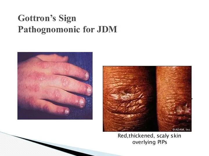 Gottron’s Sign Pathognomonic for JDM Red,thickened, scaly skin overlying PIPs